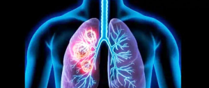 अगर दिख रहे ये लक्षण तो आप हो सकते हैं Lung Cancer के शिकार, ऐसे करें बचाव