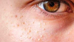 चेहरे पर है छोटे-छोटे सफेद दानों की भरमार तो अपनाएं ये घरेलू उपाय, कुछ ही दिनों में हो जाएंगे गायब