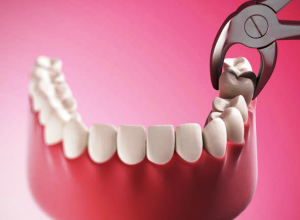 अक्‍ल दाढ़ क्‍या होती है, इसके आने पर होने वाले दर्द को दूर करने के देसी उपाय