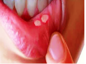 शरीर में ये बदलाव ओरल कैंसर के हैं लक्षण, ऐसे करें बचाव