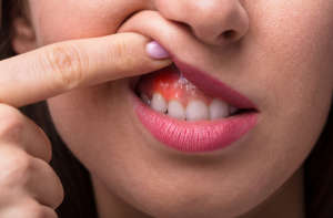 मसूड़ों के सूजन के घरेलू उपचार : Home Remedies for Gum Swelling