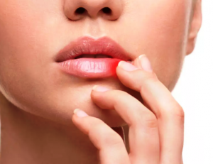 मुंह में छाले होने के कारण, इलाज और घरेलू उपचार – How To Get Rid Of Cold Sores in Hindi