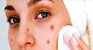 आजमाएं ये 5 घरेलू नुस्खें और कर दें चेहरे से पिम्पल्स की छुट्टी