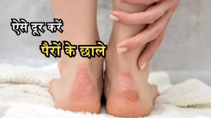 Shoe Bite Remedies: नए जूते या चप्पल से आपके पैरों में भी पड़ जाते हैं छाले, तो इन टिप्स से मिलेगा आराम