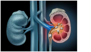 आखिर कैसे बनने लगती है किडनी में पथरी? जानें कैसे करें बचाव