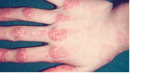 डर्मेटोमायोसाइटिस खतरनाक बीमारी जानें किस उम्र के लोगों को ज्यादा होती है