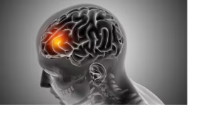 ब्रेन हेमरेज कैसे होता है, क्या सच में इसमें दिमाग की नसें फट जाती हैं?