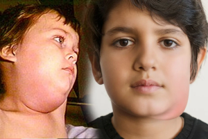 अभी तक इस गंभीर बीमारी का कोई इलाज नहीं, तेजी से बढ़ रहा है मम्प्स का प्रकोप