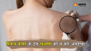 Kevin Jonas हुए Skin Cancer का शिकार, डॉक्टर्स से जानें किन लोगों में बढ़ जाता है इसका खतरा