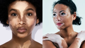 World Vitiligo Day 2024: विटिलिगो होने पर बॉडी में दिखने लगते हैं ये लक्षण, डॉक्टर से जानें सफ़ेद दाग के कारण और बचाव के उपाय