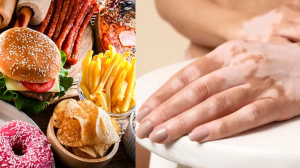 शरीर पर सफेद दाग होने लगें तो इन चीजों से कर लें तौबा, बढ़ सकती है विटिलिगो बीमारी