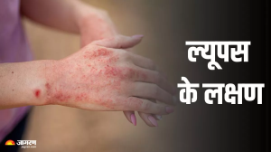 महिलाओं को ज्यादा प्रभावित कर सकता है Lupus, जानें इसके लक्षण और बचाव का तरीका