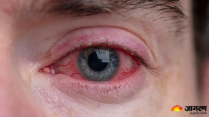 मानसून के सीजन में Eye Infection कर सकता है परेशान, बचाव के लिए अपनाएं ये 5 जरूरी टिप्स