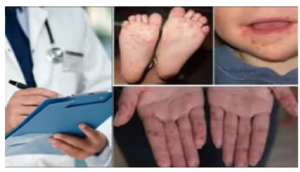 छोटे बच्चों में तेजी से फैल रही एचएफएमडी बीमारी, इन लक्षणों को देखकर हो जाएं सतर्क