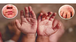 दिल्ली में बच्चों में फैल रही है ये अजीब बीमारी, हाथों-पैरों पर दिखने लगते हैं छाले