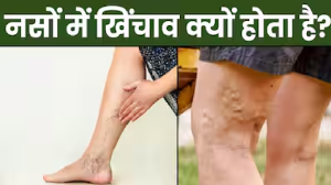 नसों में खिंचाव क्यों होता है? जानिए कम करने के तरीके