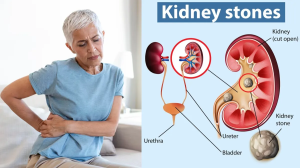 किडनी स्टोन को खत्म करने का रामबाण इलाज, गुर्दे को कैसे बनाएं स्वस्थ और मजबूत, स्वामी रामदेव से जानिए