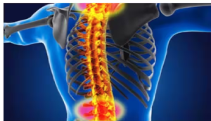 स्पाइनल मस्कुलर अट्रोफी से पीड़ित लोगों को हो सकता है फैटी लिवर : शोध