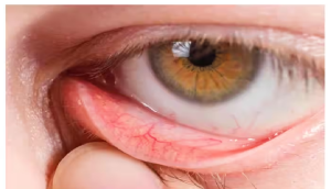 बारिश में बढ़ सकती है Dry Eye Syndrome की समस्या, जानें कैसे करें बचाव