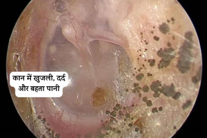 Fungal Ear Infections : मानसून में कान में फंगस का संक्रमण: कान बंद और दर्द, जानिए बचाव के उपाय