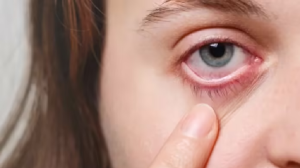 मानसून में परेशानी की वजह बन सकती हैं Pink Eye, बचाव करने के लिए अपनाएं ये तरीके